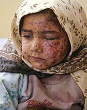 Injured Iraqi Child